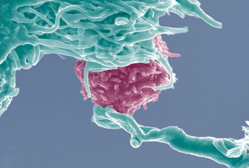 Em imagem de microscópio, células NK (em verde) conectam-se a uma célula cancerígena, para tentar romper sua membrana. Estudos demonstram que "viver na contramão" é um dos fatores para estimular defesa natural contra câncer